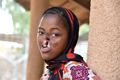 【耳学】アフリカの最貧国で 「顔が溶ける」奇病発生！！ Ichigen Sanのブログ