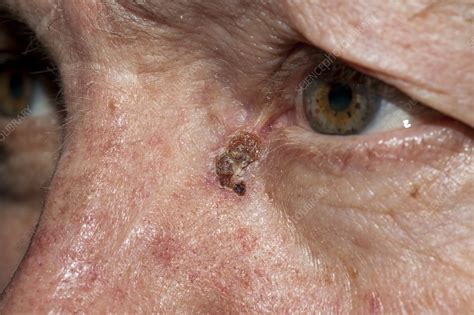 Skin Cancer Stock Image C0018473 Science Photo Library