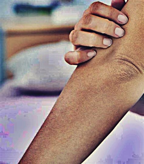 Itchy Elbows Rash Causes Treatment