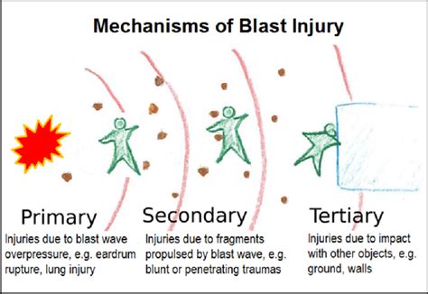 Schematic Representation Of Blast Injury Mechanisms Download