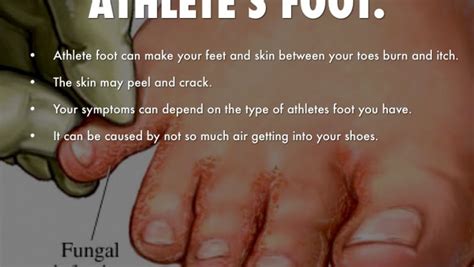 Athletes Foot Tinea Pedis — Foot Solutions Australia Foot And Ankle