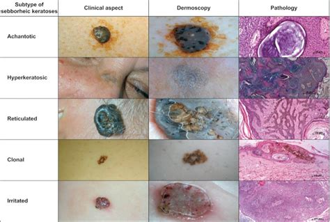 The Five Main Subtypes Of Seborrheic Keratosis Pathological Pictures
