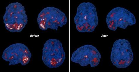 Neurofeedback Treatment For Post Traumatic Stress Disorder Braintrainuk