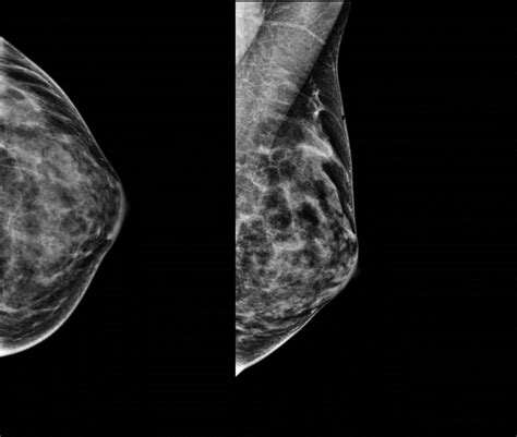 57 Year Old Woman Left Palpable Nodule Without Mammographic Findings
