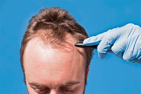 Certain Kind of Baldness at Age 45 Linked to Increased ...
