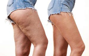 When a person has an injection within 5 days of a period starting, it works immediately. Does CoolSculpting Work on Cellulite? - MyBotoxLA Blog