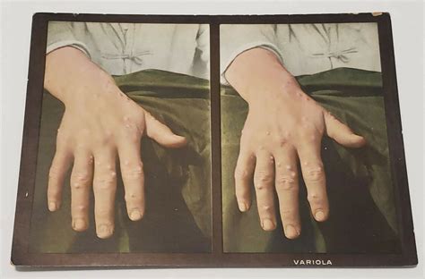 Vintage Stereoview Card Medical Very Graphic Picts Woman 1910 Am 4620