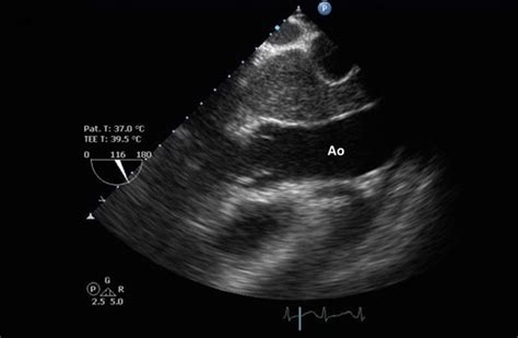 Case Report Of Aggressive Primary Pericardial Mesothelioma Presenting