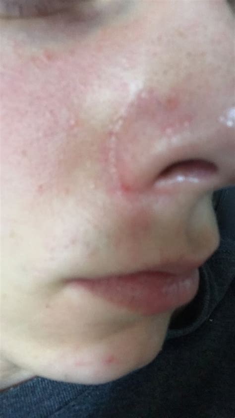 Skin Concerns How Do I Deal With Bumpsredness On My Cheeksnose R