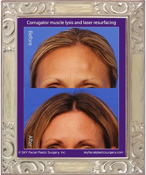 Corrugator Muscle Lysis Frown Lines Removal — Sky Facial Plastic Surgery