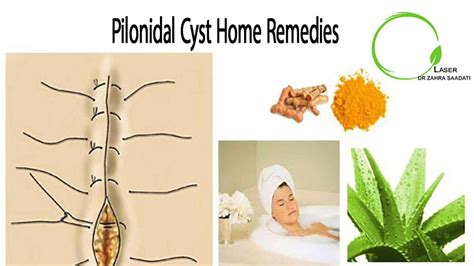 Home Remedies For Pilonidal Sinus