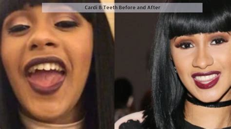 Cardi B Teeth Transformation Before And After Facts