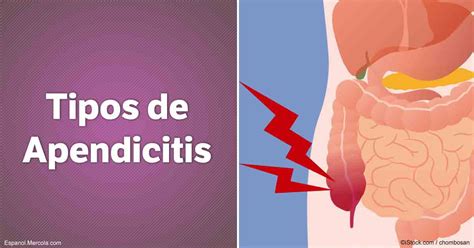 Apendicitis