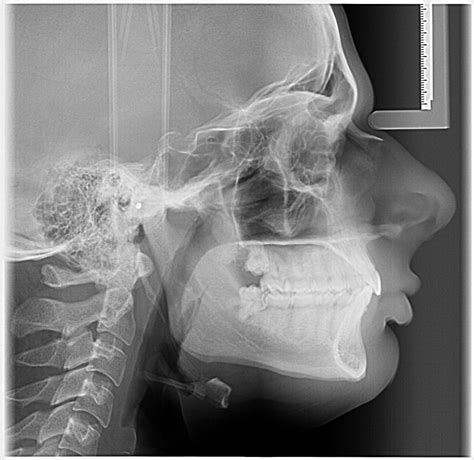 I Cant Detect Any Problems With My X Ray But My Side Profile Is