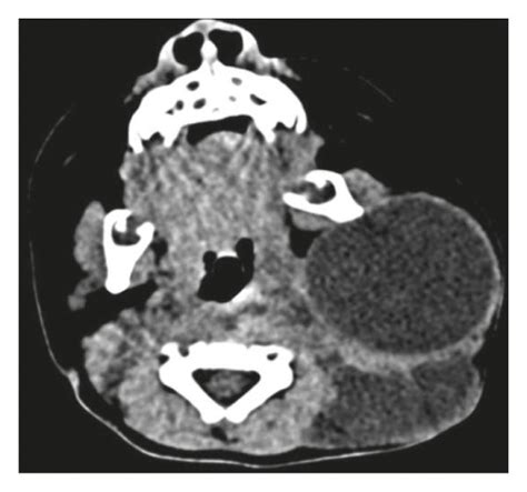 Axial Computed Tomography Showing Left Cervical Cystic Hygroma
