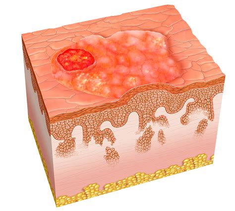 Squamous Cell Carcinoma Net Health Book