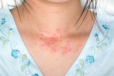 Guide To Allergic Skin Rashes