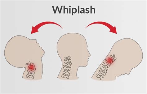 Whiplash And Pain Preventation Seattle Chiropractic Spine And Injury