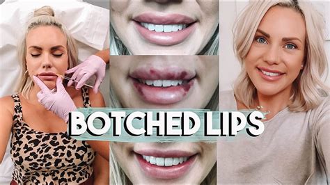 Botched Lips Having My Lip Filler Dissolved The Procedure Before And After Youtube