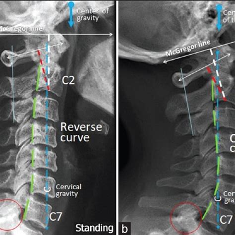 Initial And Follow Up Radiographs Of Case 3 A Initial Radiograph
