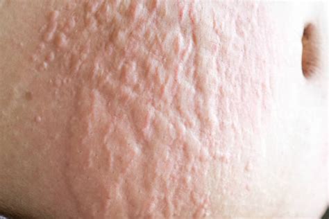 60 Different Skin Rashes Stock Photos Pictures And Royalty Free Images