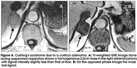 Scielo Brasil Imaging Procedures In Adrenal Pathology Imaging