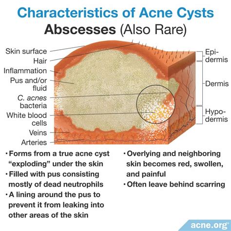 What Is An Acne Cyst