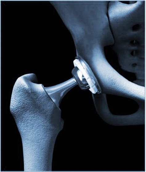 New Method For Hip Replacement Wins Favor With Some Surgeons The