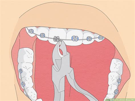 How To Fix A Popped Out Wire On Braces Wiring Work