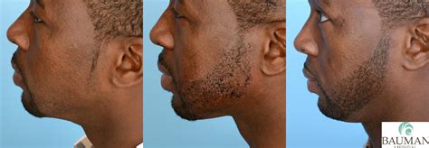 Again, hair transplant on black african american man is very delicate and unique. Beard & Mustache Transplantation Results · Bauman Medical