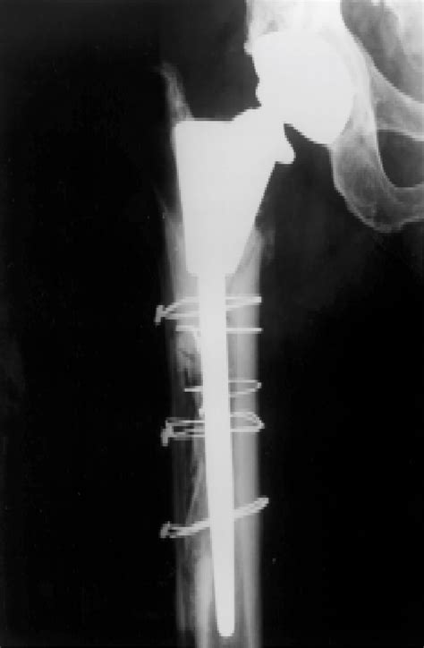 Figure 2 From Periprosthetic Fracture Of The Femur After Hip