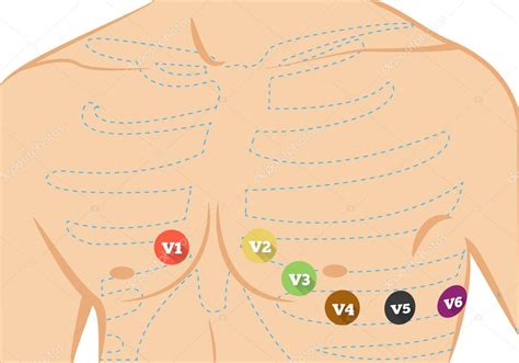 Chest Ecg Leads Placement Illustration Six Colored