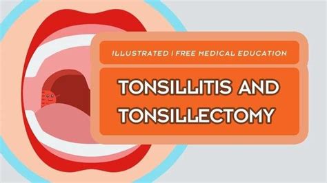 What Is Tonsillitis And Tonsillectomy