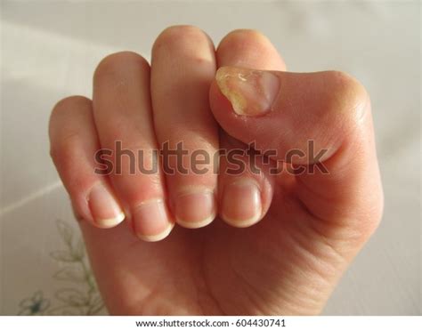 Close Nail Fungus Infection On Big Stock Photo Edit Now 604430741
