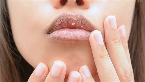 6 Natural Remedies For Dry Lips Shefinds