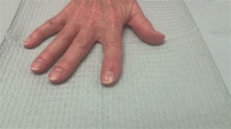 Right Index Finger Mucous Cyst Excision With Local Advancement Flap