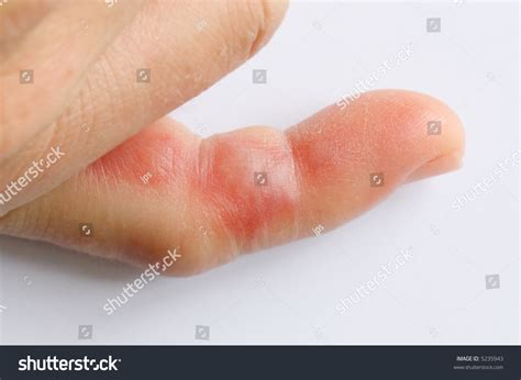 Bee Sting On Swollen Finger Stock Photo 5235943 Shutterstock