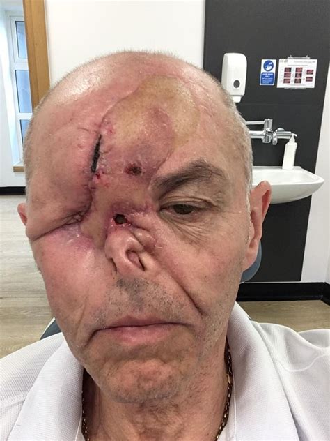 Quite to the contrary, he is more than. How a watery eye led to 'alien' cancer taking over man's ...