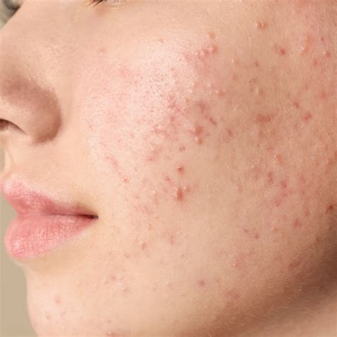How To Remove Pimples And Pimple Marks Juicy Chemistry