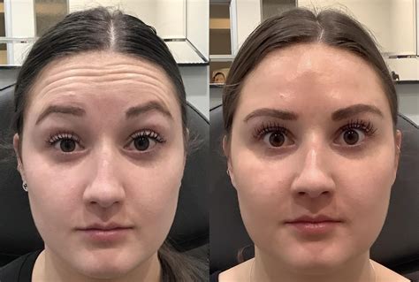 Botox Dysport Before And After Pictures Case Sacramento Ca