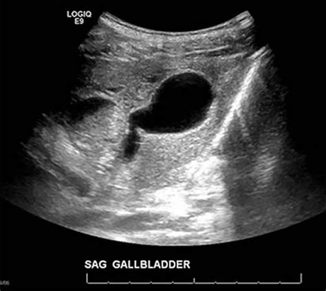 Complicated Triple Gallbladder Clinical Presentation And Surgical