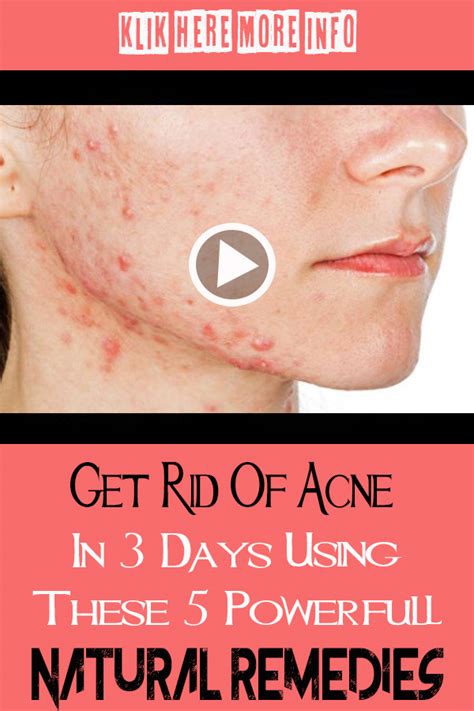 Natural Skin Care Tips For Acne To Get Rid Of Your Symptoms Fast