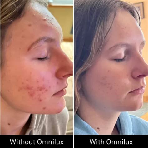 Omnilux Clear Led Mask