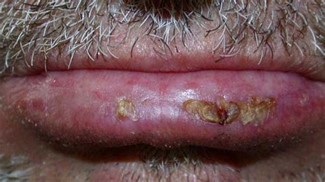 Actinic Cheilitis Symptoms Treatments Causes And More