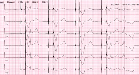 Normal Dual Chamber Pacing With Atrial And Ventricular Pacemaker
