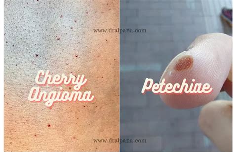Cherry Angioma Vs Petechiae Understanding The Differences
