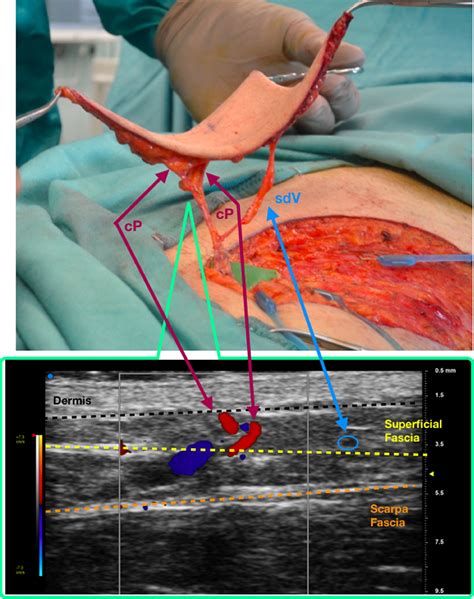 Ultra High Frequency Ultrasound In Planning Capillary Perforator Flaps
