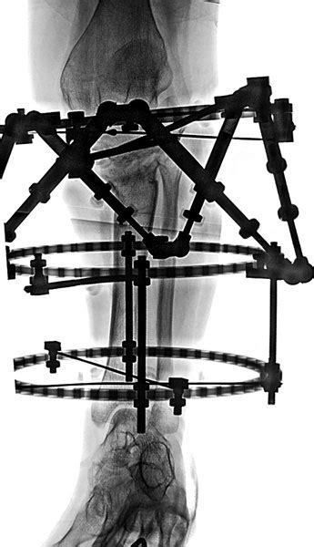 Ap Radiograph Of The Left Tibia After Completion Of Rotational