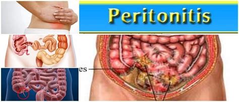 Peritonitis Causas S Ntomas Diagn Stico Tratamiento Complicaciones