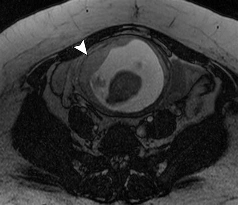 Mr Imaging Findings Of Ectopic Pregnancy A Pictorial Review